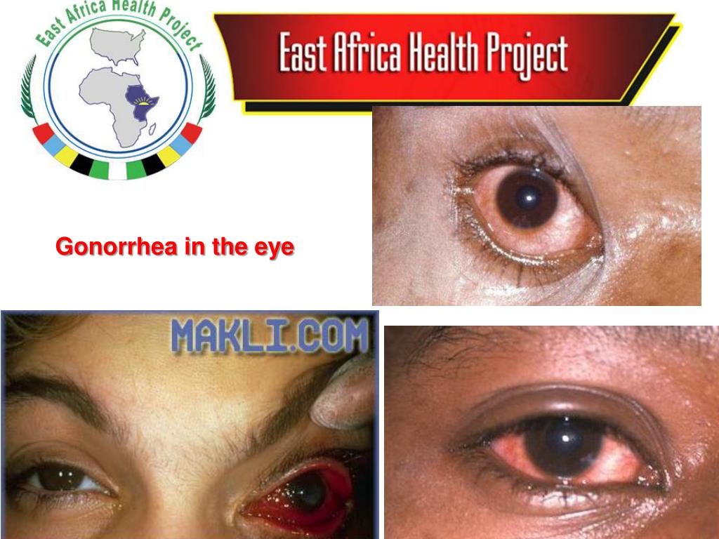 PPT Gonorrhea PowerPoint Presentation, free download ID3427141