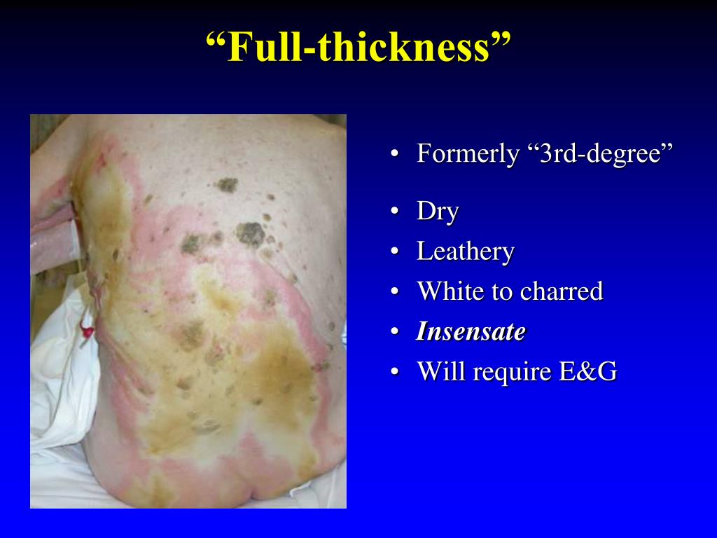 PPT Burn Care in the 21 s t Century PowerPoint Presentation, free download ID3427196