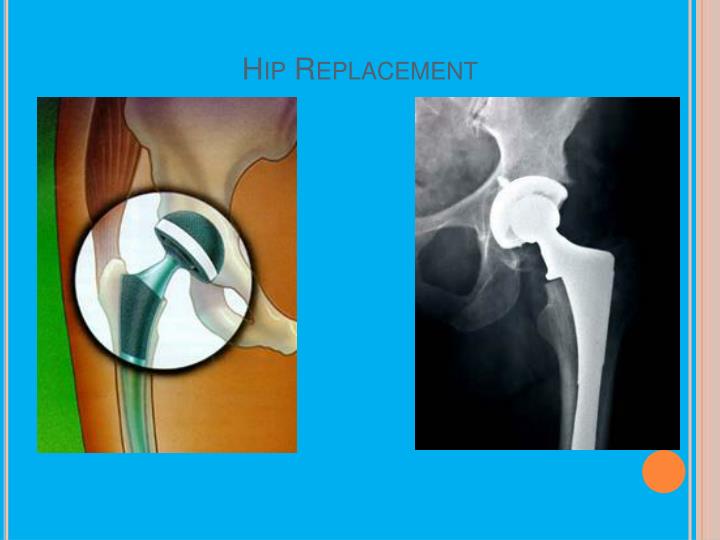 3 Titanium Implant Side Effects and How to Minimize Your Risk