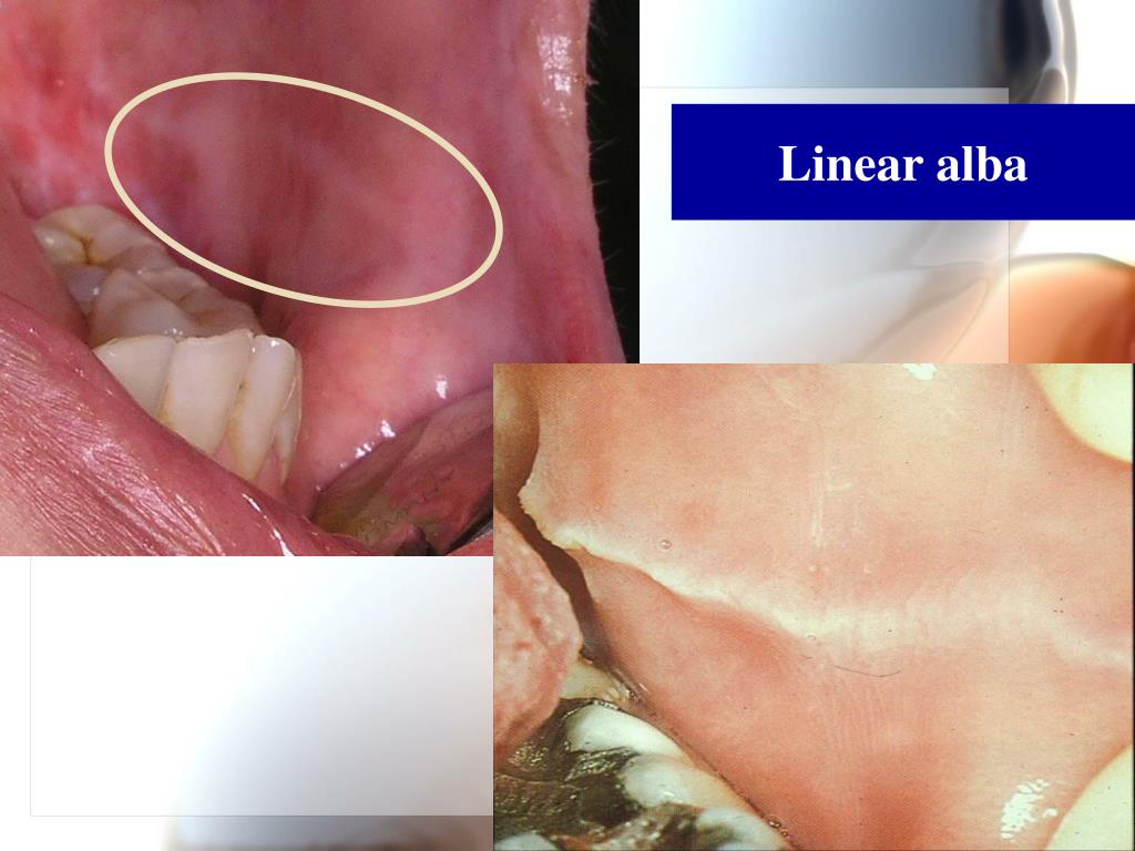 PPT 1. White lesions of the oral mucosa 2. Solitary oral ulcer and