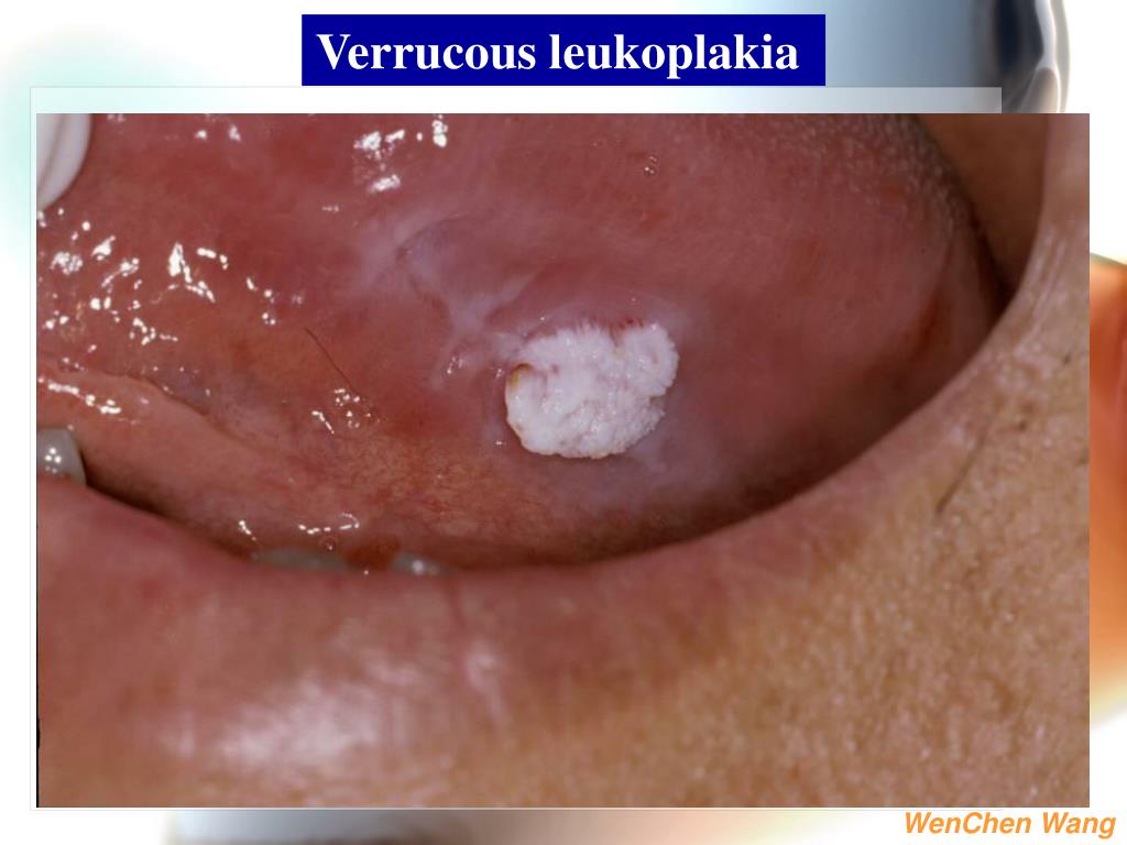 PPT 1. White lesions of the oral mucosa 2. Solitary oral ulcer and