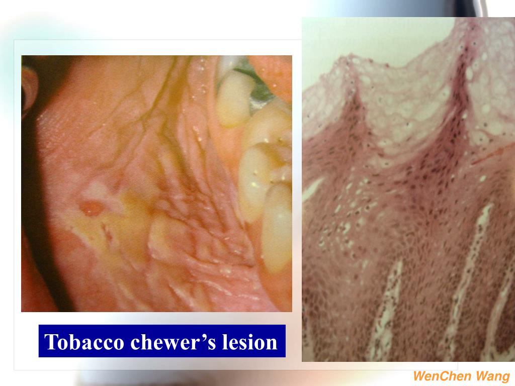 PPT 1. White lesions of the oral mucosa 2. Solitary oral ulcer and fissures PowerPoint