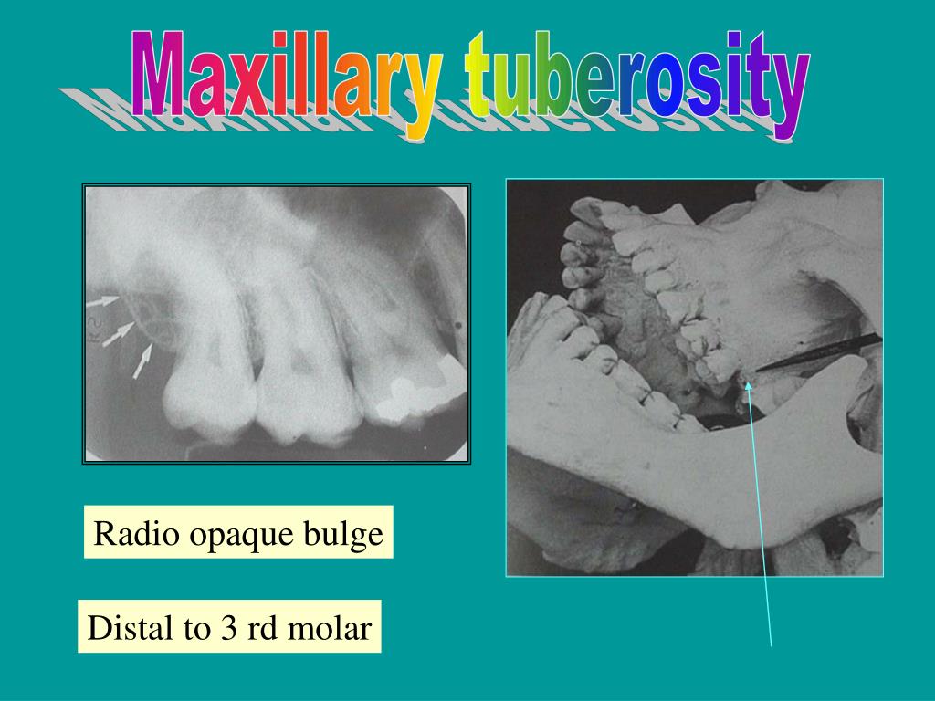 PPT NORMAL ANATOMICAL RADIOGRAPHIC LANDMARKS PowerPoint Presentation ID3477892