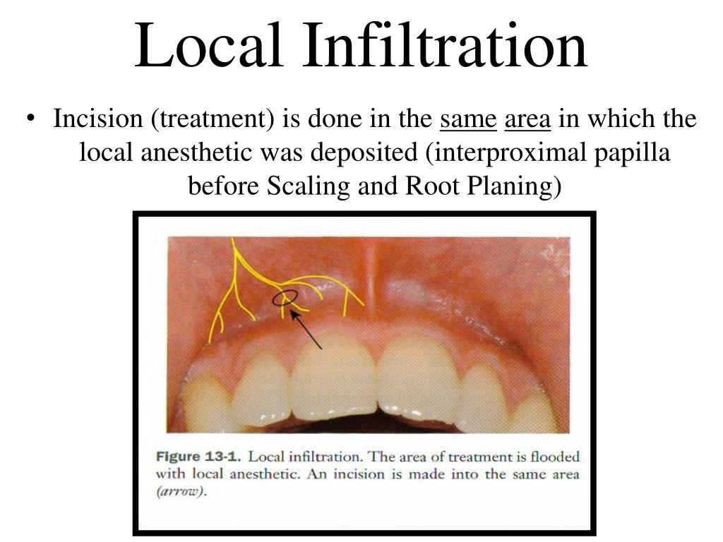 PPT Maxillary Injection Techniques PowerPoint Presentation, free