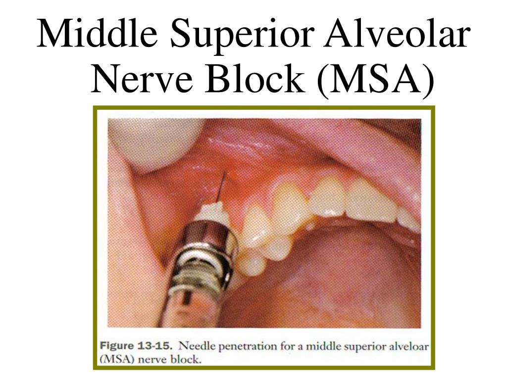 PPT Maxillary Injection Techniques PowerPoint Presentation, free