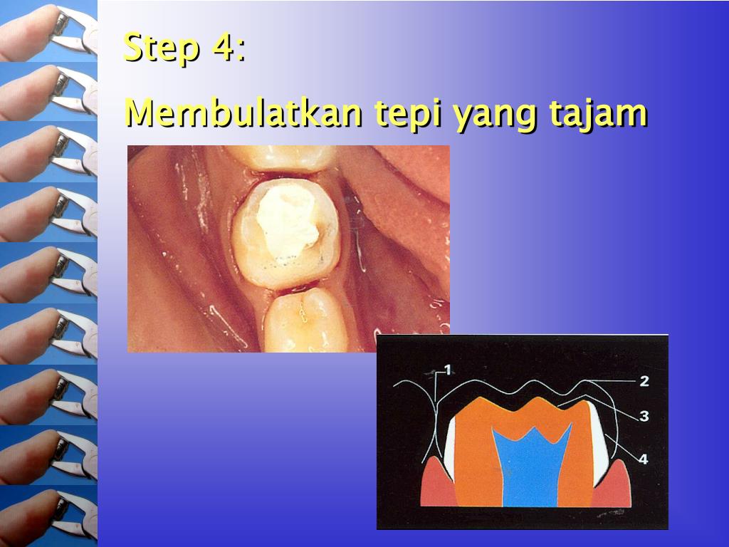 PPT Stainless Steel Crown PowerPoint Presentation, free download ID