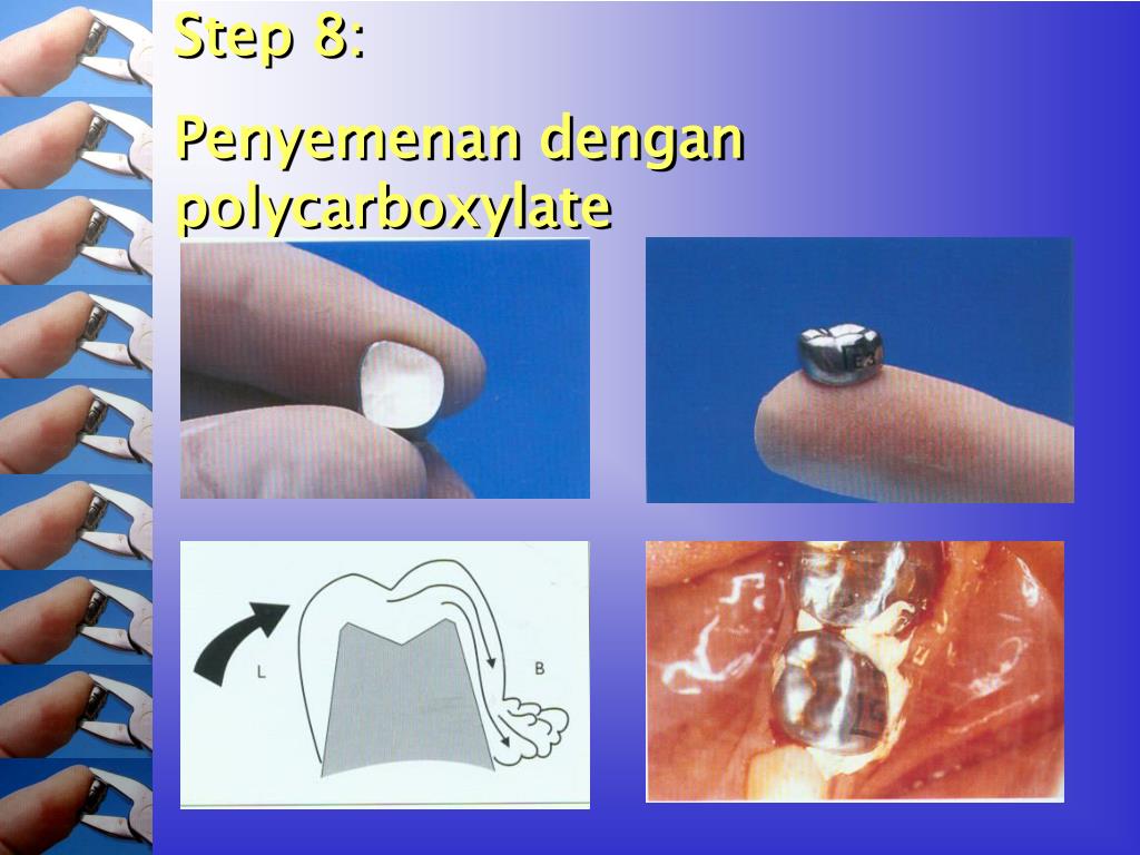 PPT Stainless Steel Crown PowerPoint Presentation, free download ID