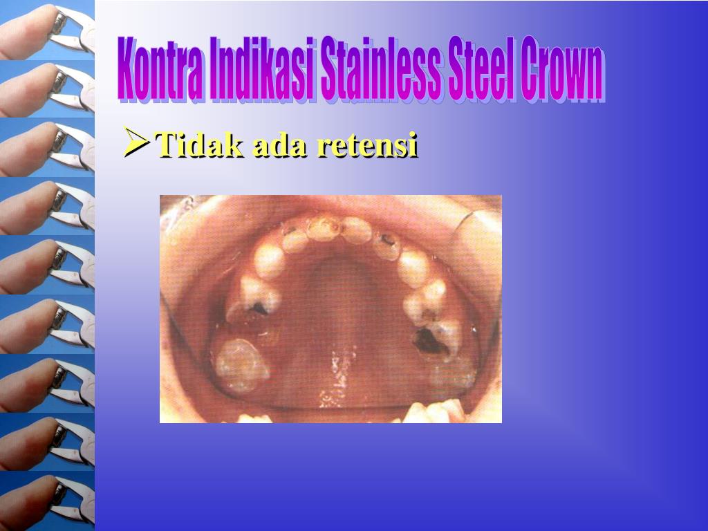 PPT Stainless Steel Crown PowerPoint Presentation, free download ID