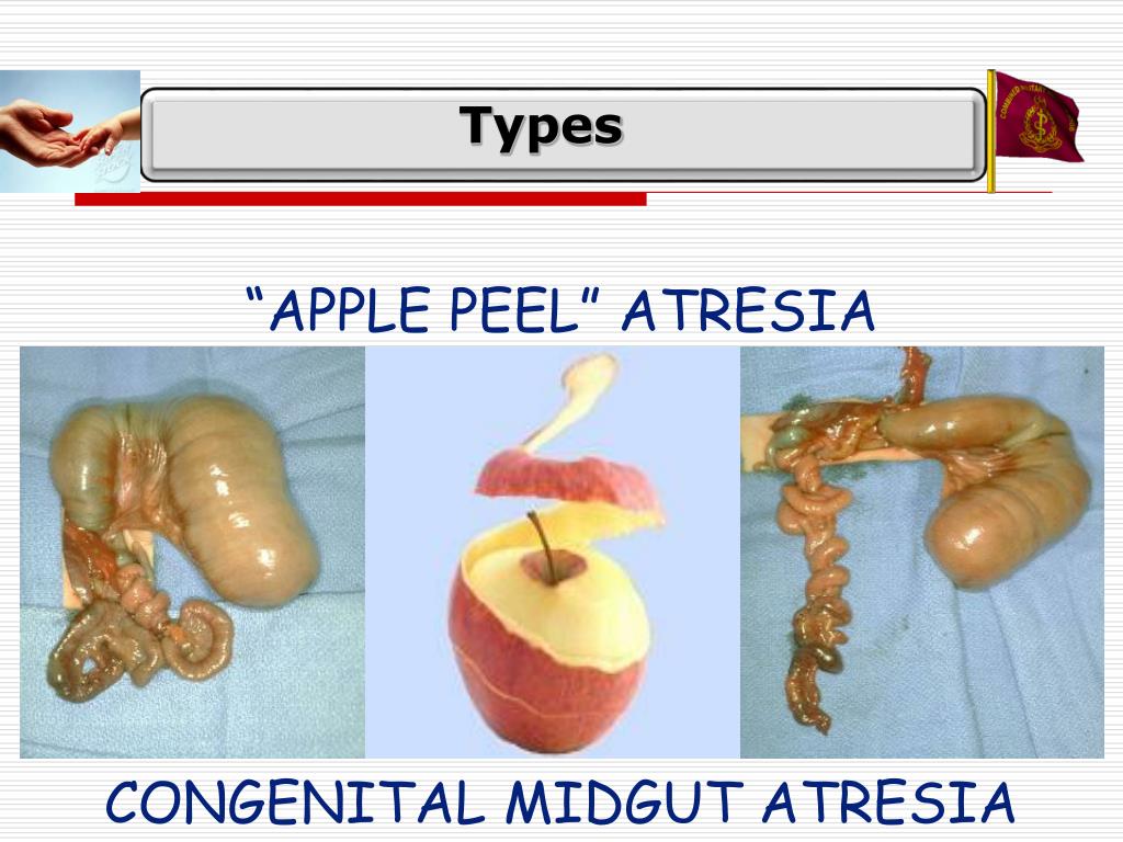PPT INTESTINAL OBSTRUCTION PowerPoint Presentation, free download