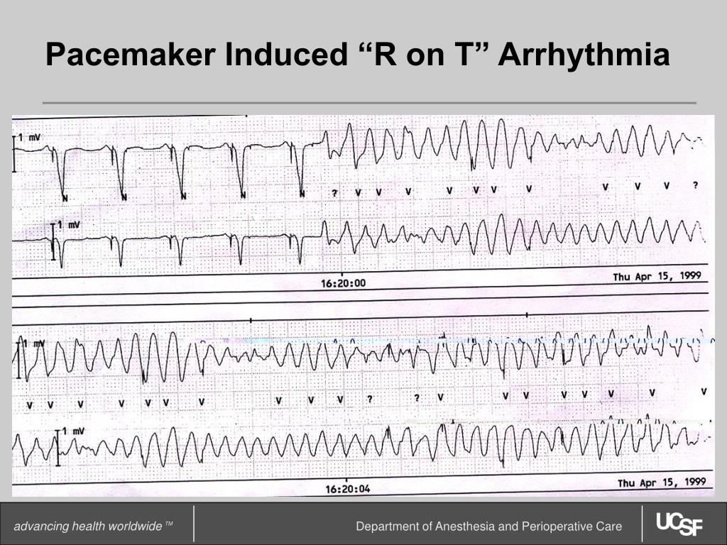 PPT Combined ICD/Pacing Devices PowerPoint Presentation ID3506265