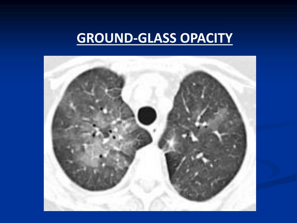 PPT Alveolar / Airspace lung disease Acute,chronic and ground glass