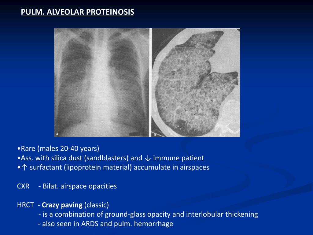 PPT Alveolar / Airspace lung disease Acute,chronic and ground glass