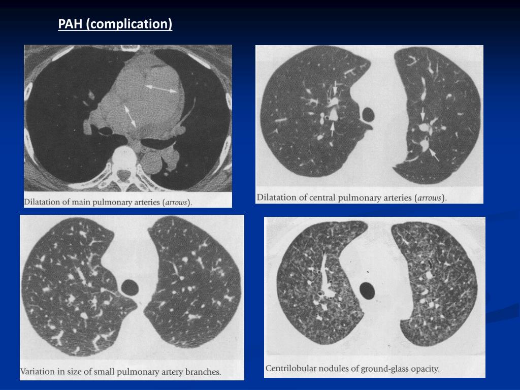 PPT Alveolar / Airspace lung disease Acute,chronic and ground glass
