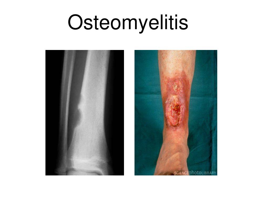 PPT Osteomyelitis PowerPoint Presentation, free download ID3554818