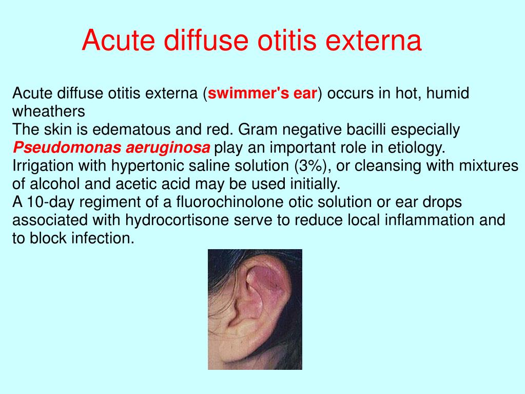 Acute Otitis Media With Perforation