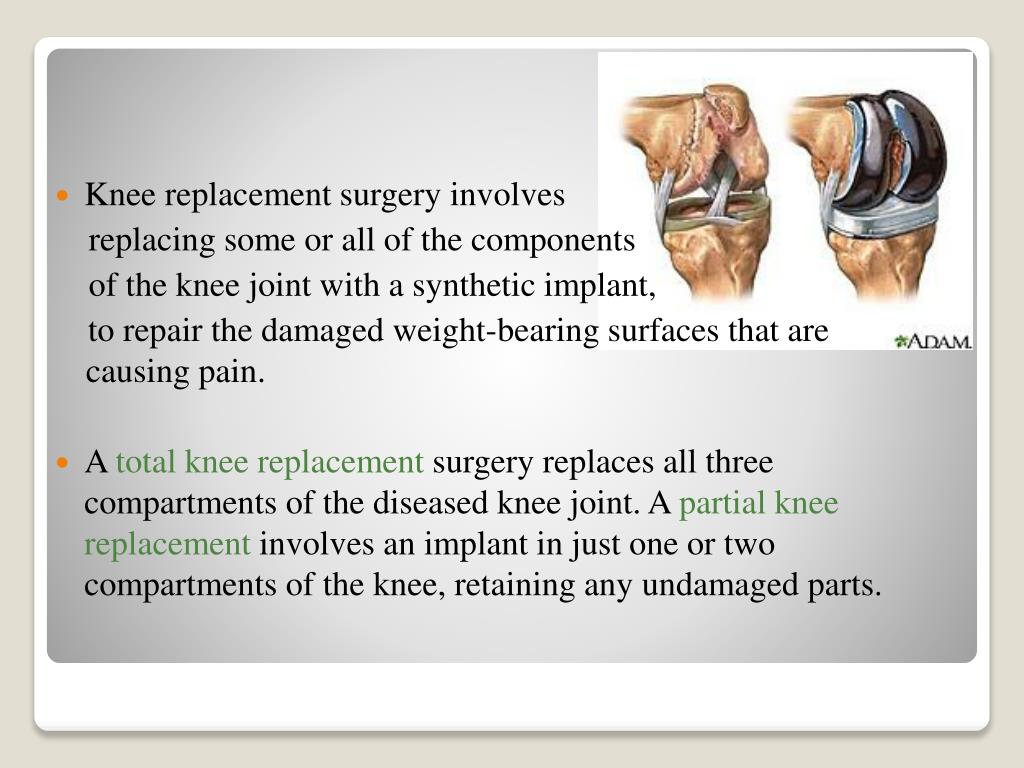 PPT Total Knee Replacement PowerPoint Presentation, free download