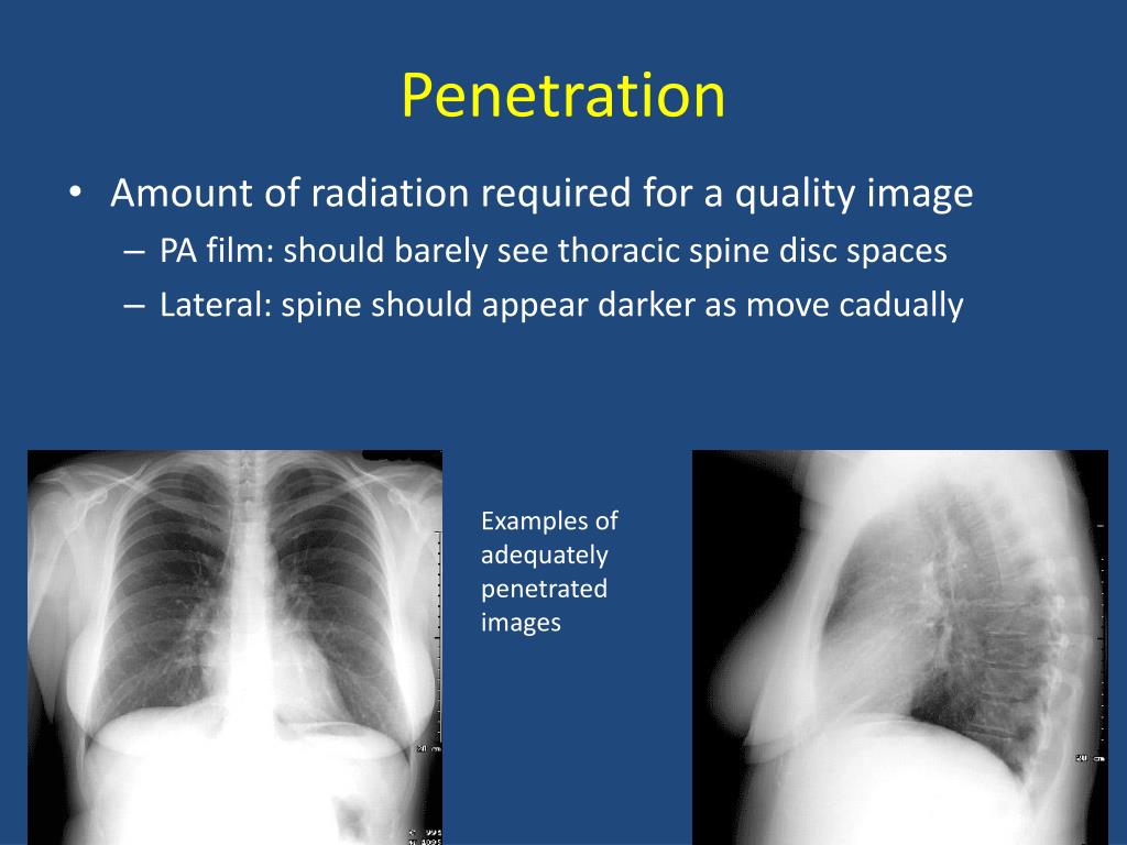 PPT Basics of Chest XRay PowerPoint Presentation, free download ID3620583