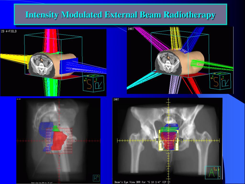 PPT Radiation Therapy for Treatment of Prostate Cancer PowerPoint