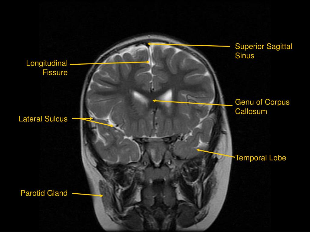 PPT MRI of Brain/Head and Neck PowerPoint Presentation, free download
