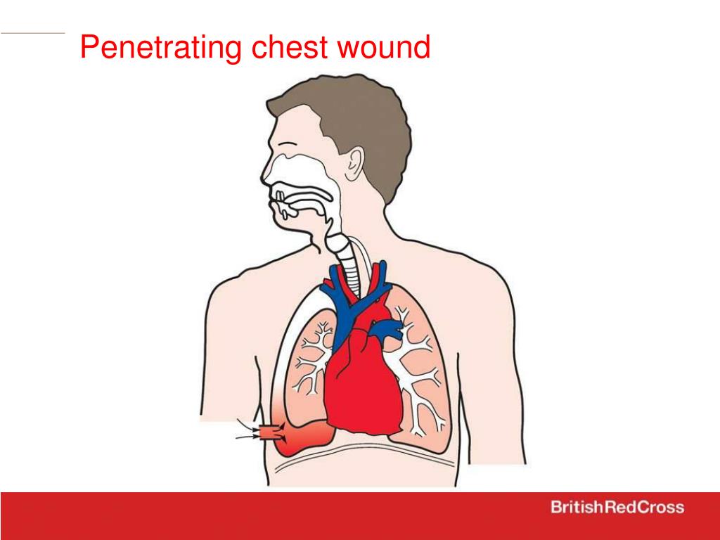 PPT First Aid PowerPoint Presentation, free download ID3659152