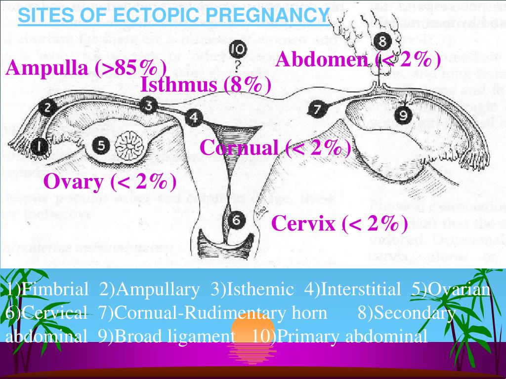 PPT Ectopic Pregnancy PowerPoint Presentation, free download ID3661174