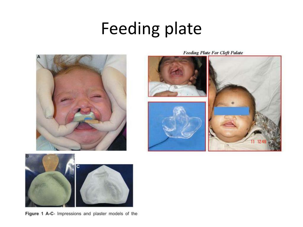 Management of Cleft Lip and Cleft Palate Statement FDI