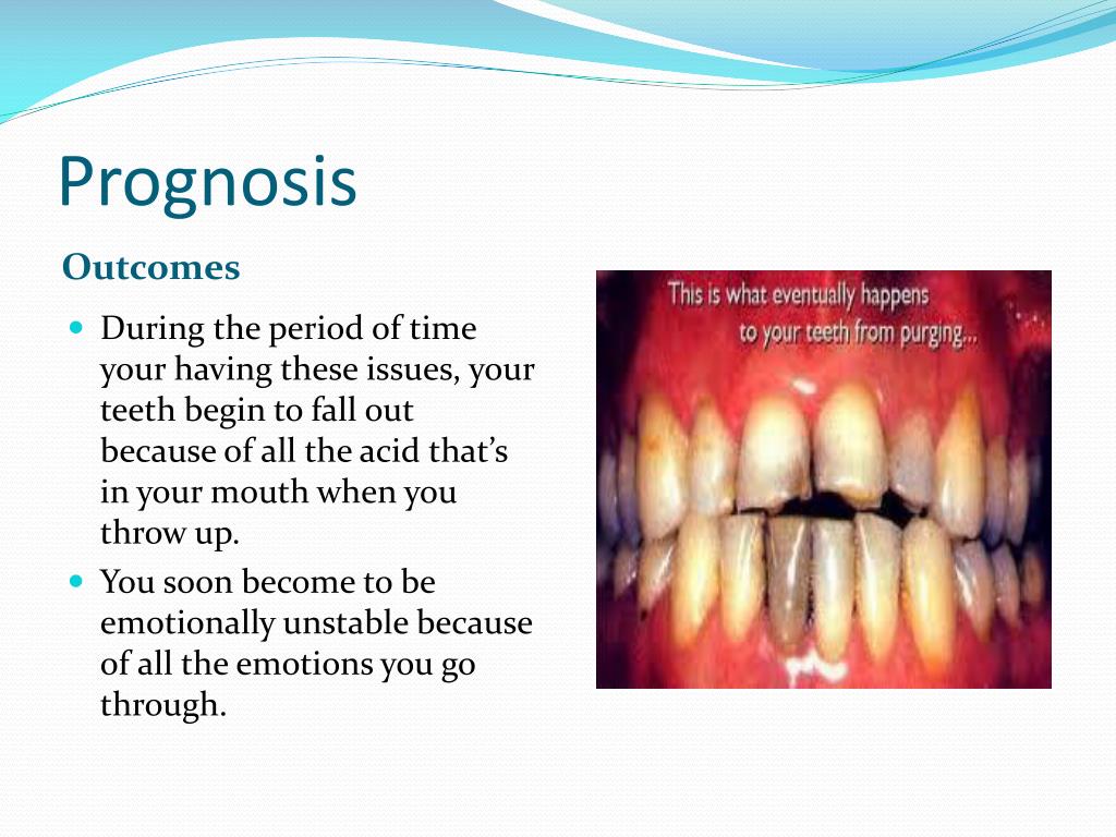 PPT Bulimia Nervosa PowerPoint Presentation, free