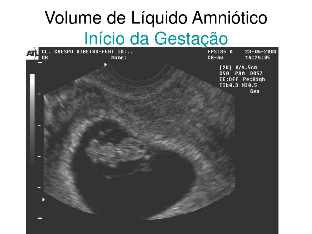 PPT Patologias do Líquido Amniótico PowerPoint Presentation, free
