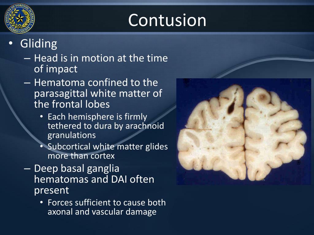 PPT Pediatric Head Trauma PowerPoint Presentation, free download ID
