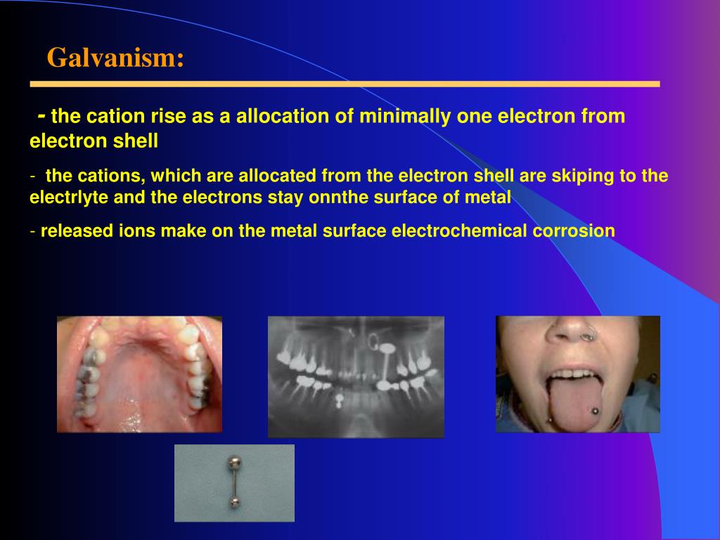 PPT The Distribution of dental alloys ; Corrosion ; Galvanism