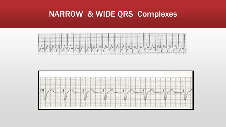 PPT EKG PowerPoint Presentation ID3835591