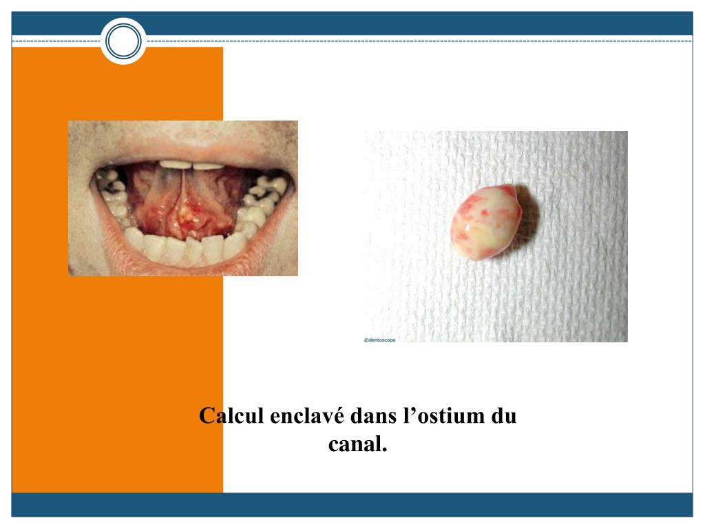 PPT Maladies des glandes salivaires PowerPoint Presentation, free download ID3837983