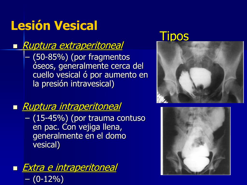 PPT Traumatismo Genitourinario PowerPoint Presentation, free download