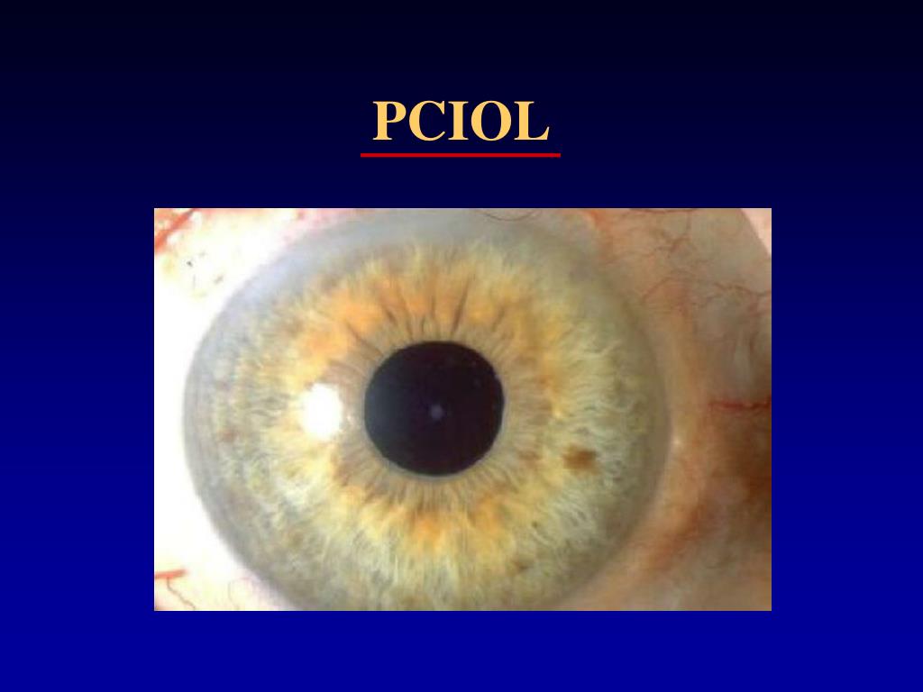PPT Common Eye Disorders PowerPoint Presentation, free download ID