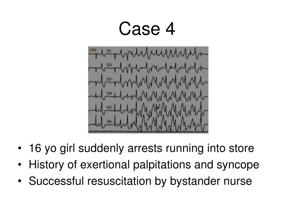 PPT Normal Heart VT PowerPoint Presentation, free download ID3953111
