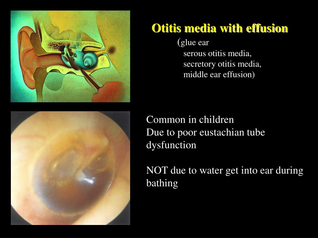 PPT Diseases of Middle Ear PowerPoint Presentation, free download