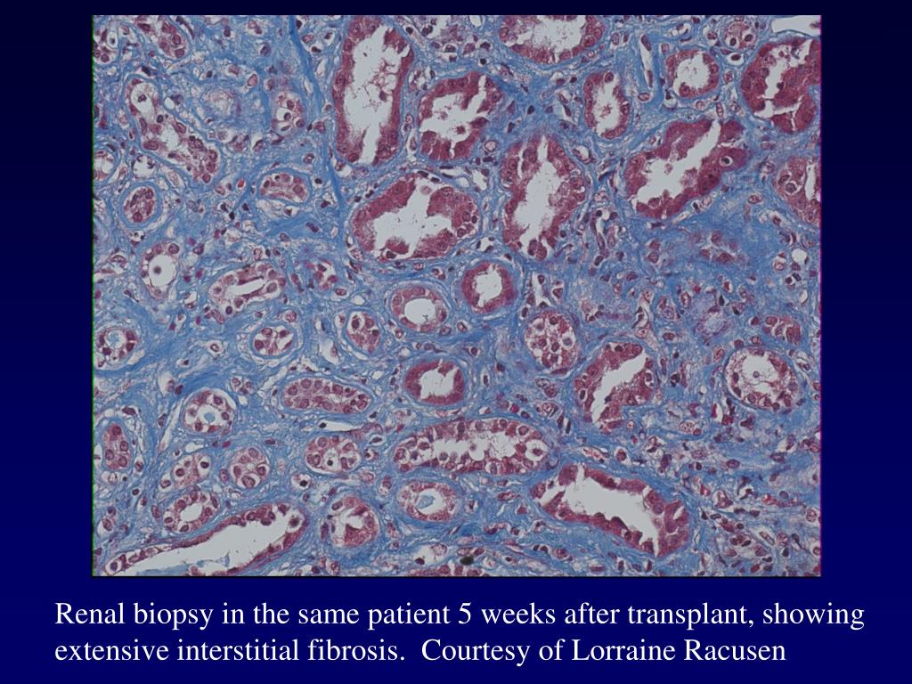 PPT L. G. Hunsicker, M.D. Professor of Internal Medicine Carver