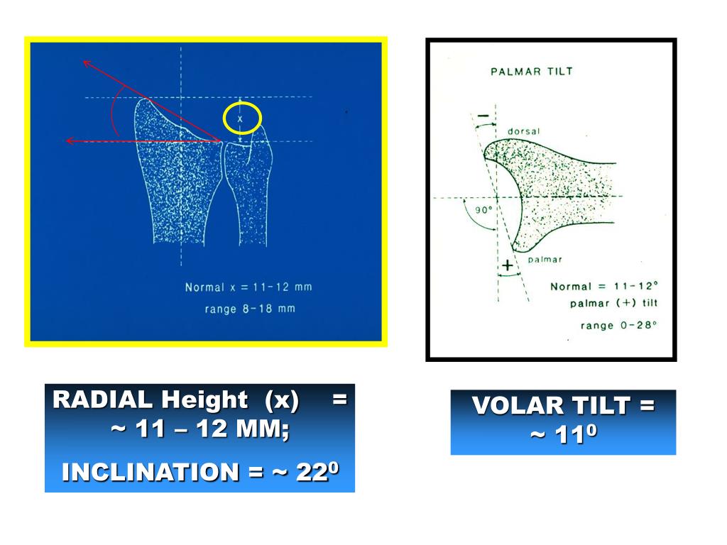 PPT Distal Radius Fractures PowerPoint Presentation, free download