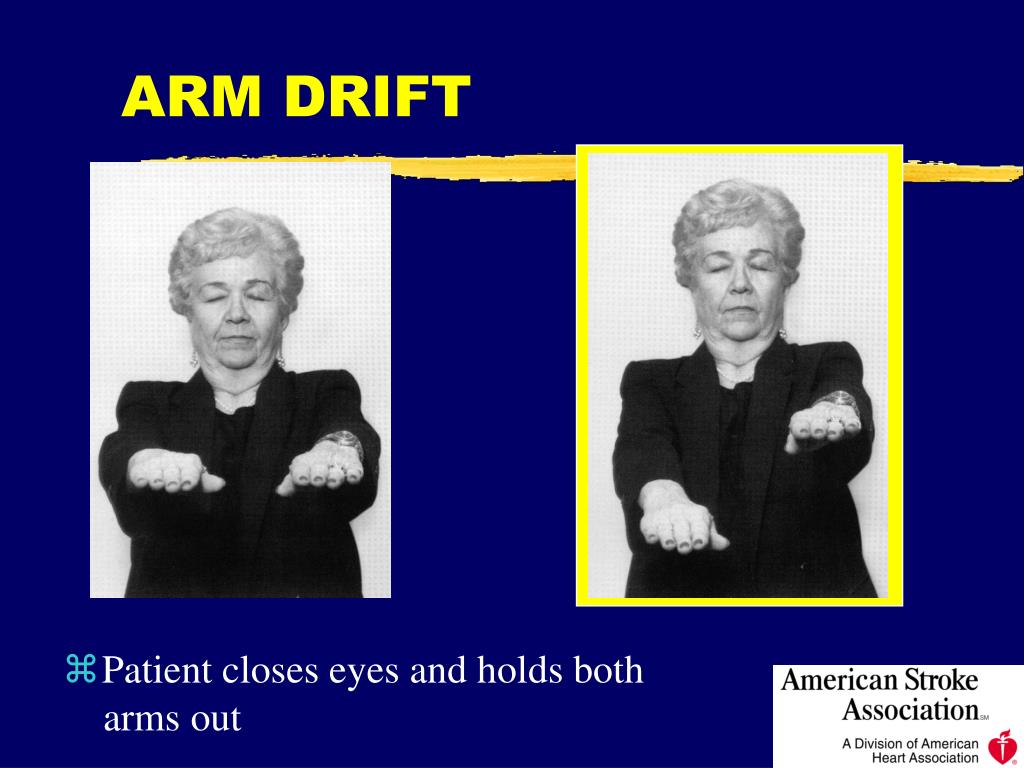 PPT Cerebral Vascular Accidents PowerPoint Presentation, free