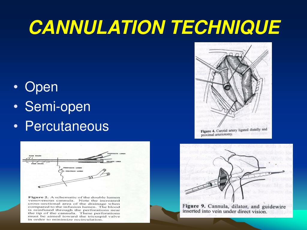PPT Vascular Access & Cannulation Dr Osama Bawazir PowerPoint