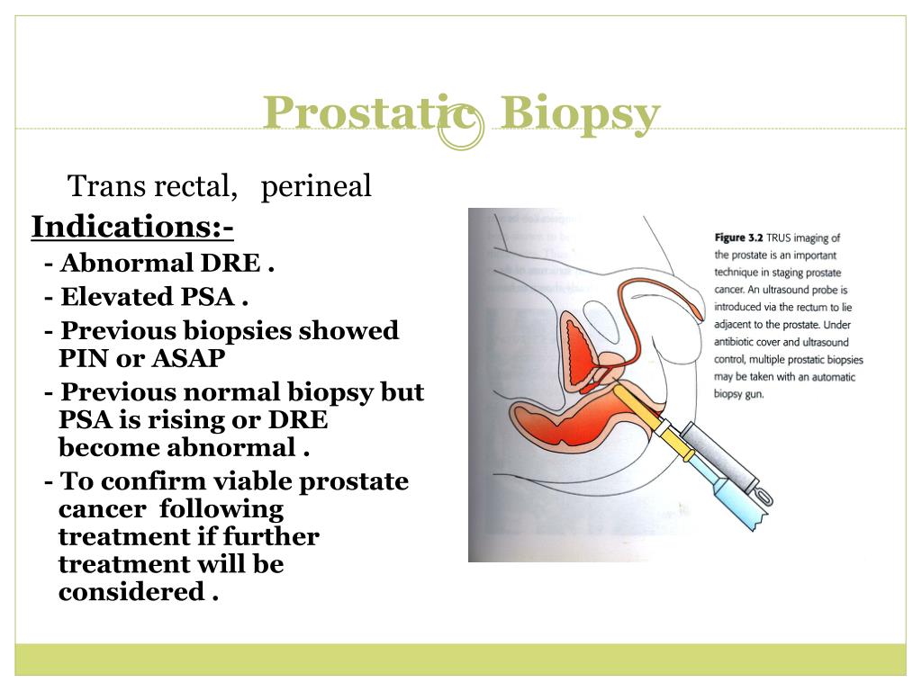 PPT Localized Prostate Cancer PowerPoint Presentation, free download