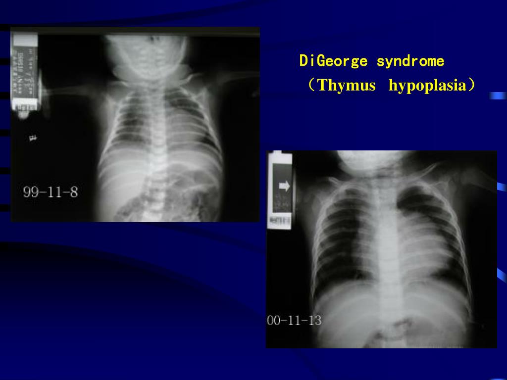 PPT Primary Immunodeficiency Disease （ PID ） PowerPoint Presentation