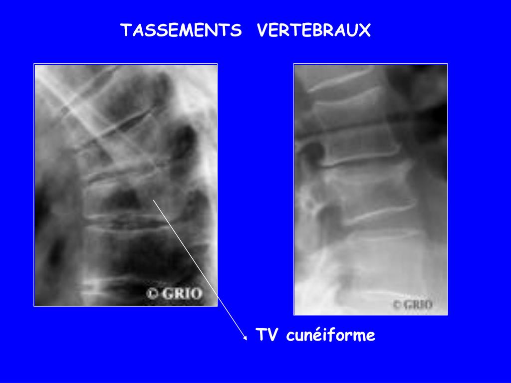 PPT OSTEOPATHIES PowerPoint Presentation, free download