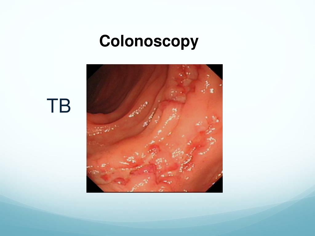 PPT Intestinal Tuberculosis PowerPoint Presentation