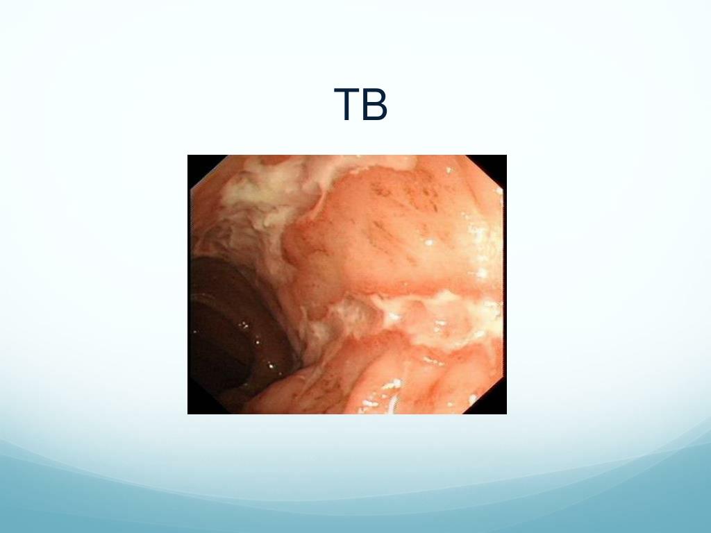 PPT Intestinal Tuberculosis PowerPoint Presentation, free download