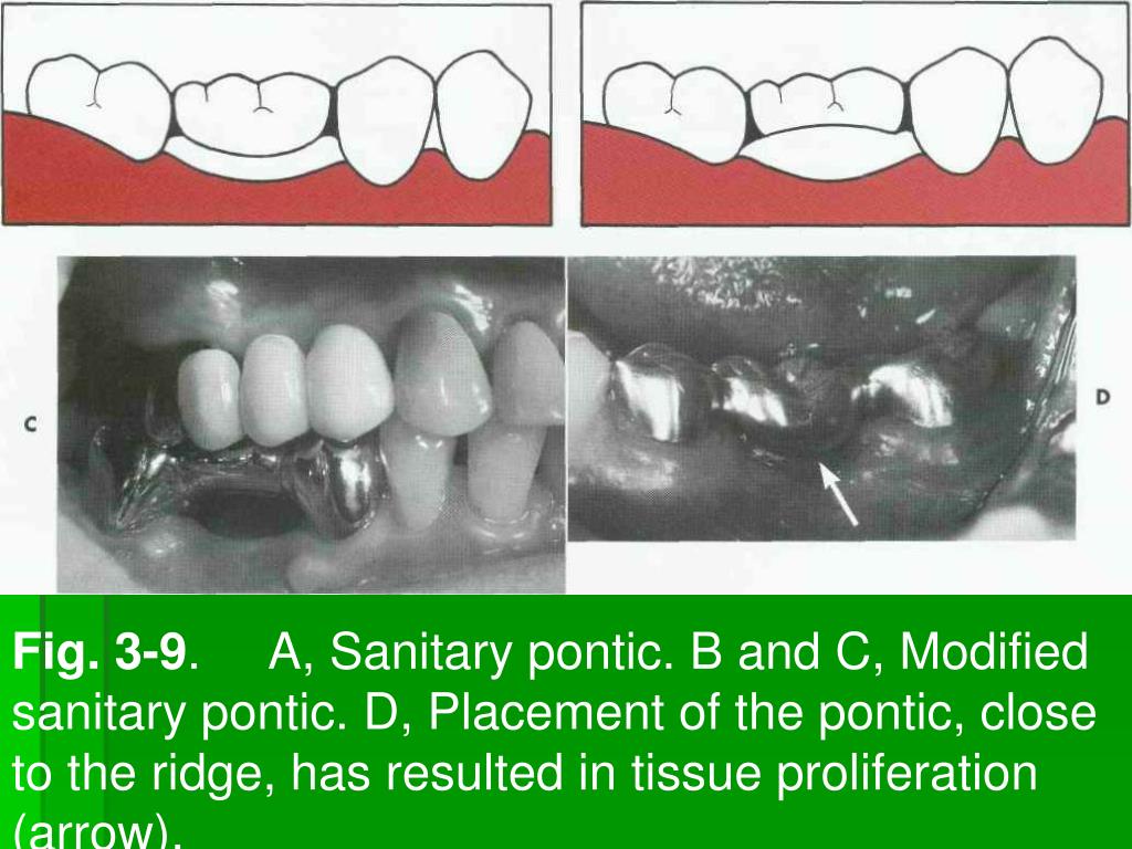 PPT Dental bridges (pontics). Clinical and technological aspects