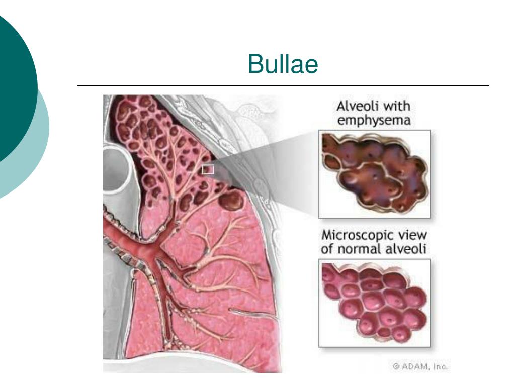 PPT Chronic obstructive pulmonary disease PowerPoint Presentation