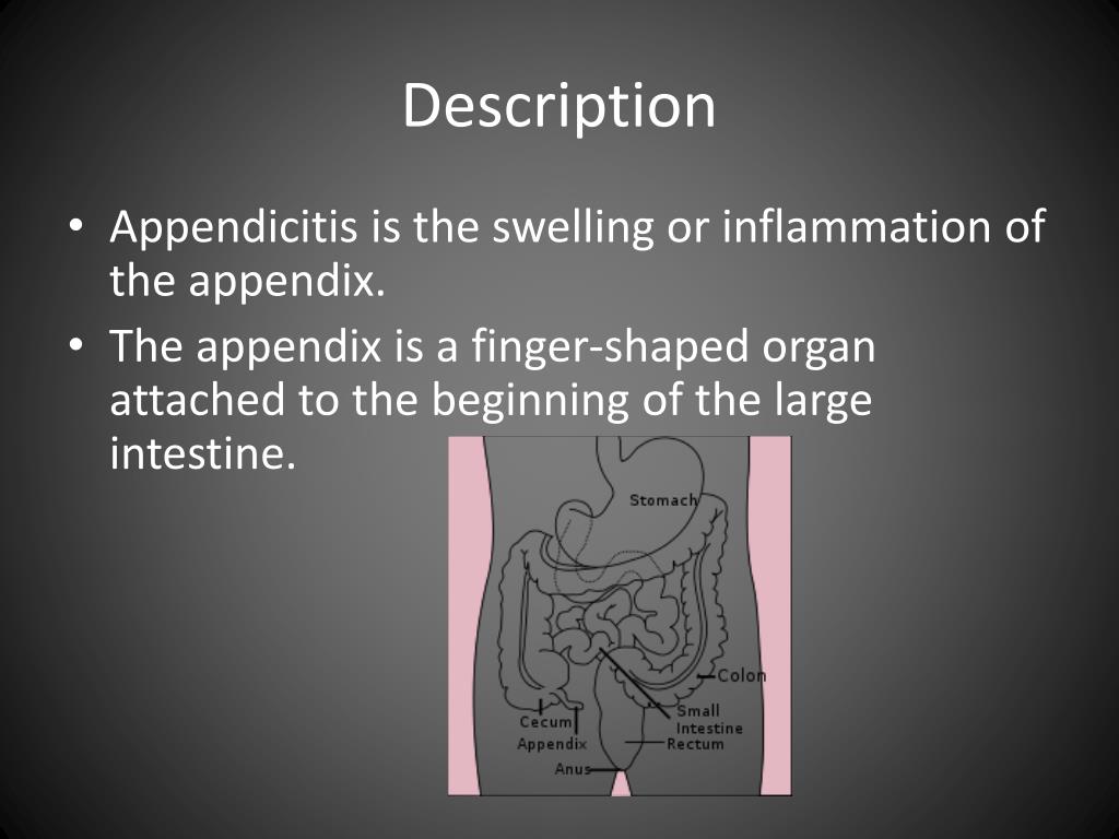 PPT Appendicitis PowerPoint Presentation, free download ID4175359