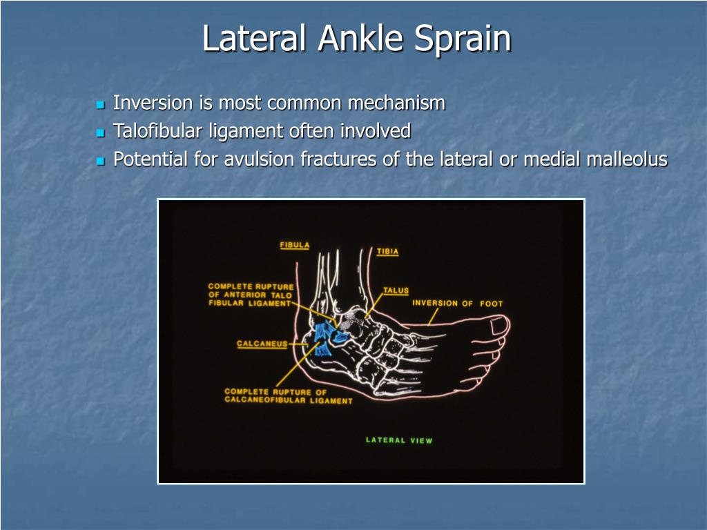 PPT Anterior Talofibular Ligament Sprain of the Ankle PowerPoint