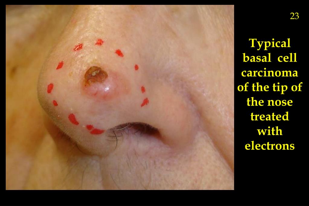 PPT Section 8 Radiation Oncology Dosimetry CPT Codes 77300 77370 PowerPoint Presentation